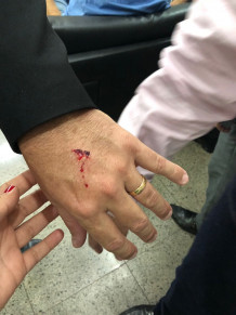 Agressão Fecomércio - mão Amarilton Casal